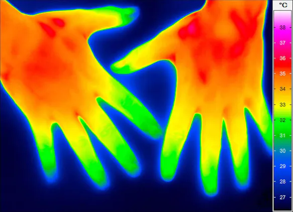 Hands after the regulation therapy