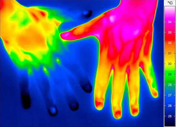 Hand thermography before and after regulation therapy